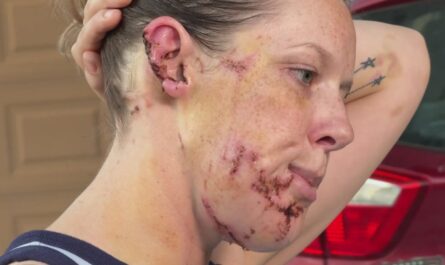 Mother Describes Fear for Her Life After Brutal Dog Attack in Her Own Home