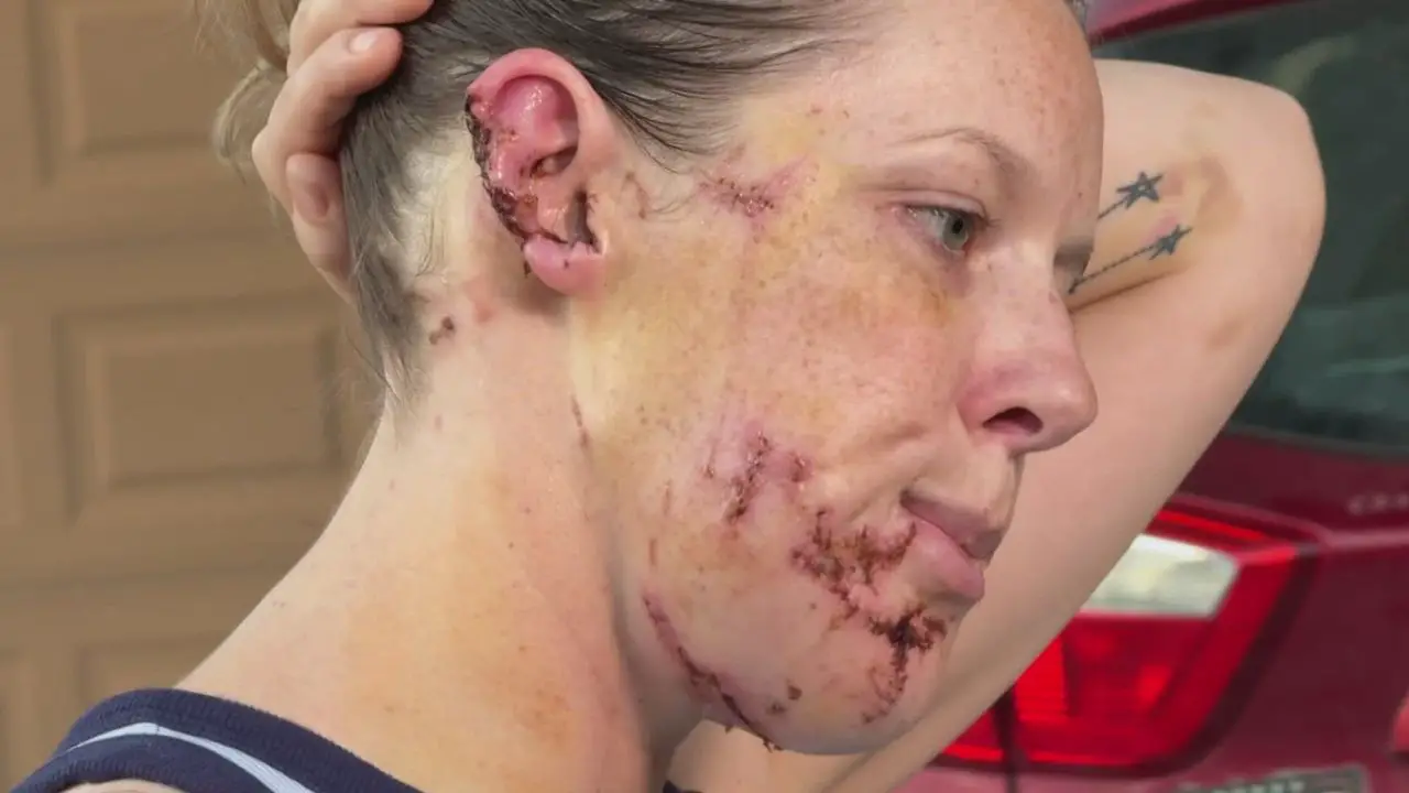 Mother Describes Fear for Her Life After Brutal Dog Attack in Her Own Home