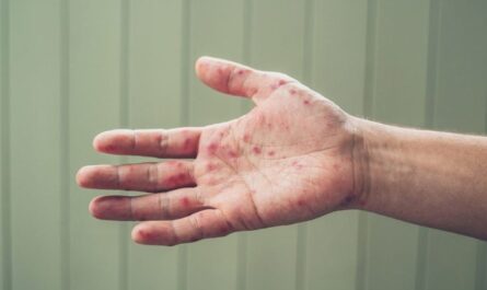 Measles Warning Issued as Travel Increases and Exposure Window Extends Up to Three Weeks