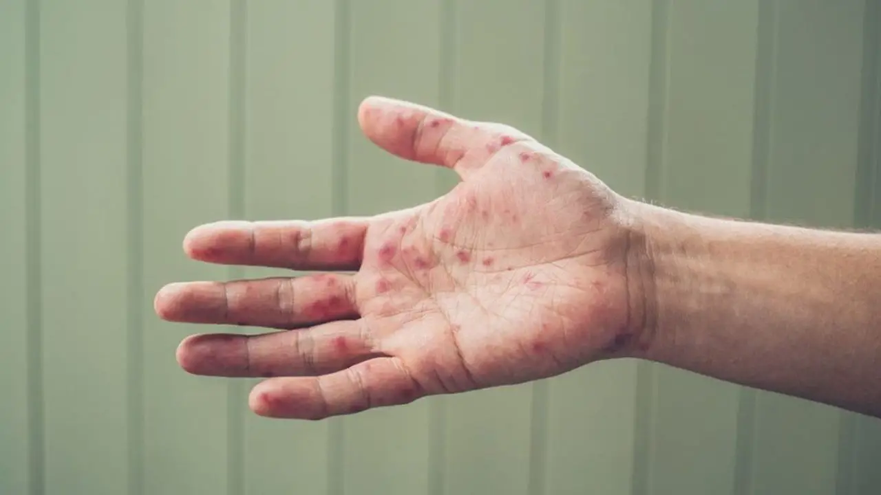 Measles Warning Issued as Travel Increases and Exposure Window Extends Up to Three Weeks